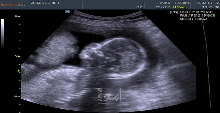 جنين يختفي في رحم والدته ويترك لتوأمه علامة مميزة .. شاهد