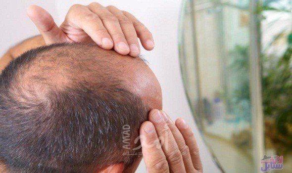 ساعات العمل الطويلة تزيد من إصابة الرجال بالصلع