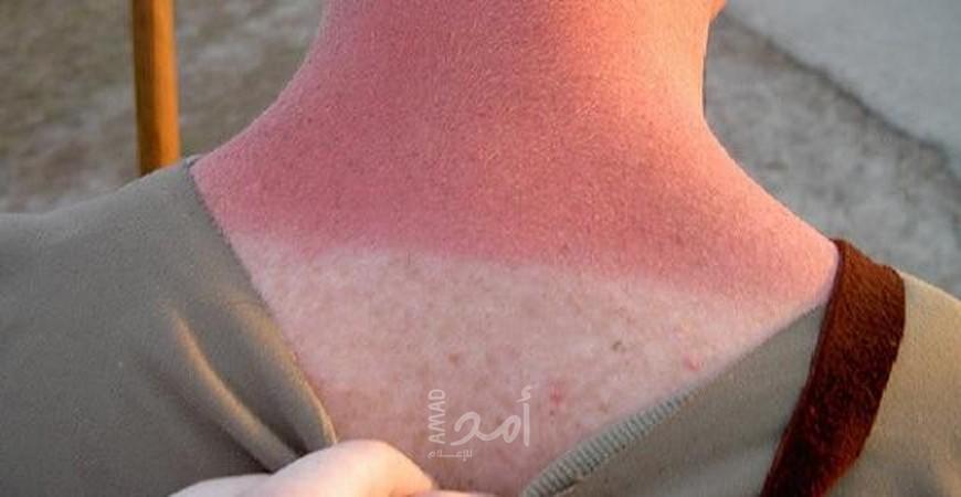 ماذا يحدث بالجسم عند التعرض لحروق الشمس ؟
