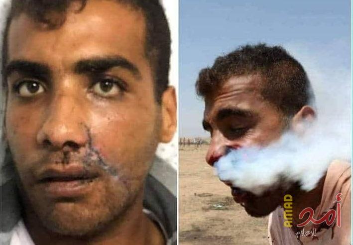 تحسن الحالة الصحية للجريح "هيثم أبو سيلة" الذي استهدف بقنبلة غاز مباشرة بالوجه شرق غزة