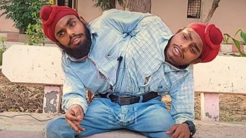 توأم هندي ملتصق يحصلان على أول وظيفة لهما بعد19عامًا من تخلي والديهما عنهما
