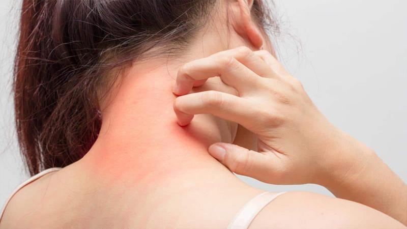 "حمامات التبييض" طريقة لعلاج الإكزيما والأمراض جلدية - تفاصيل