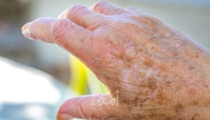 بقع بنية على الجلد.. قد تنذر بالأسوأ