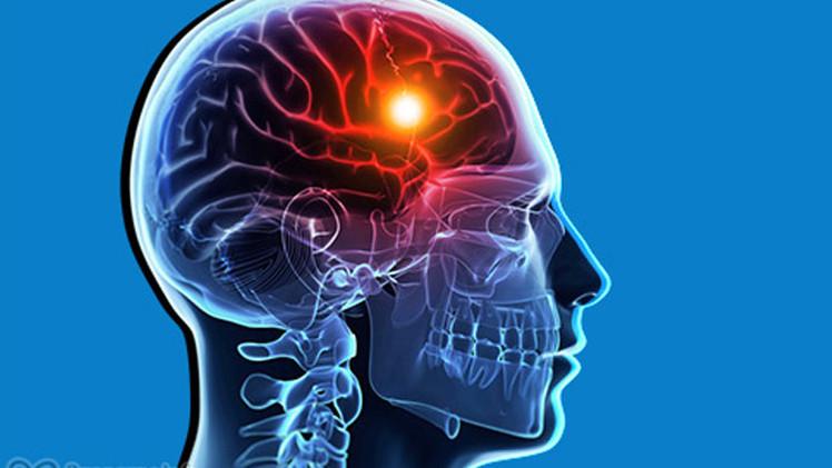 علاج الجلطة الدماغية