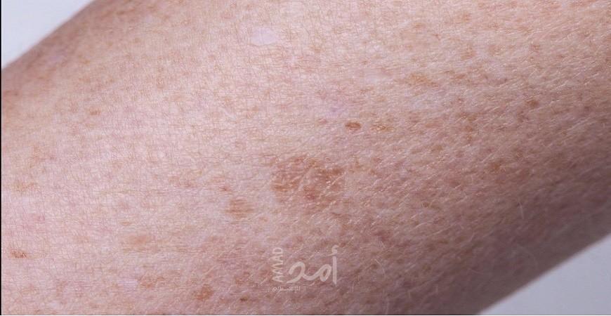 كيف تتعامل لو بتعانى من مرض الذئبة الحمراء