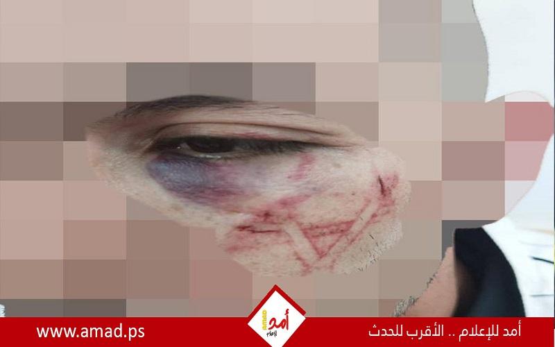 شرطة الاحتلال تعترف بحفر عناصرها "نجمة داوود" على وجه شاب فلسطيني! صور