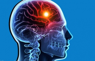 توقف عن ممارسة 4 عادات لتجنب الإصابة بالسكتة الدماغية