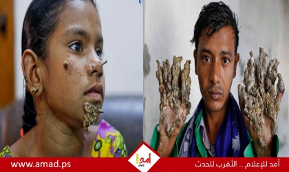 مرض نادر يحول جلد المصابين ليشبه أغصان الشجر - تفاصيل